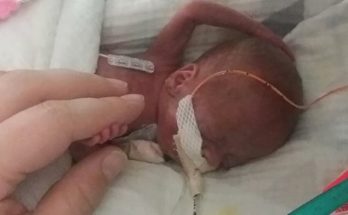 Το πιο πρόωρο μωρό στον κόσμο - Γεννήθηκε μόλις 450 γρ