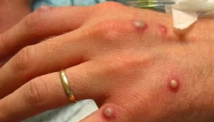 Ιταλία: Το πρώτο κρούσμα «ευλογιάς των πιθήκων» καταγράφηκε στη χώρα